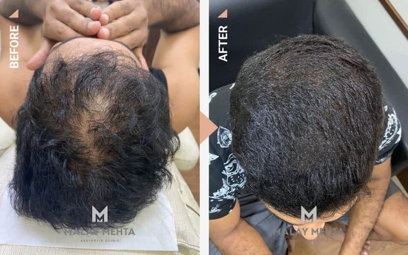 GFC before and after, 27, Male, Androgenetic alopecia