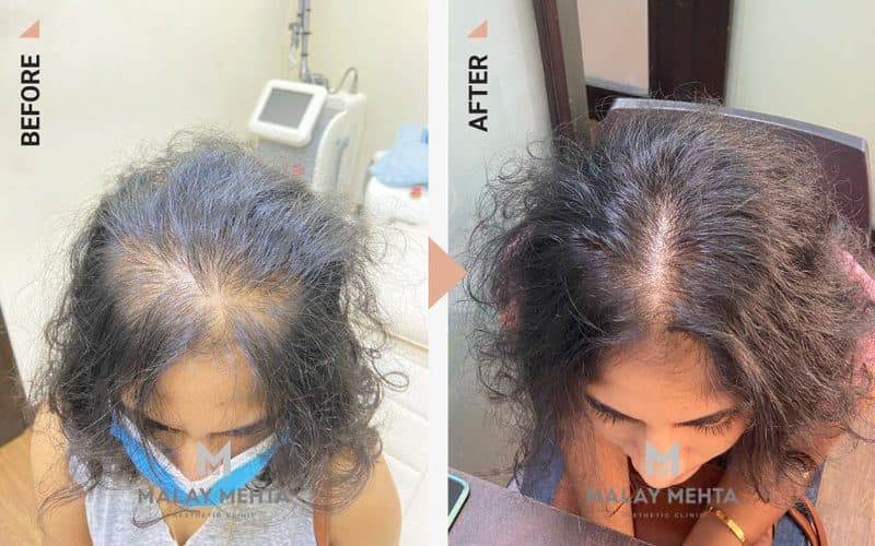 GFC before and after, 24, Female, Female pattern hair loss