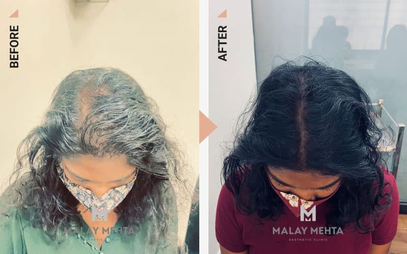 GFC before and after, 28, Female, Telogen effluvium (post-illness)